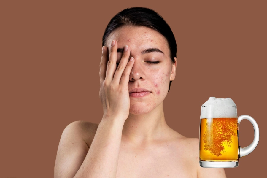 uống bia có nổi mụn không
