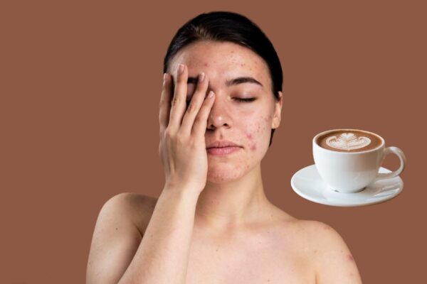 uống cà phê có nổi mụn không