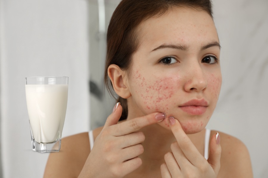 uống sữa có nổi mụn không