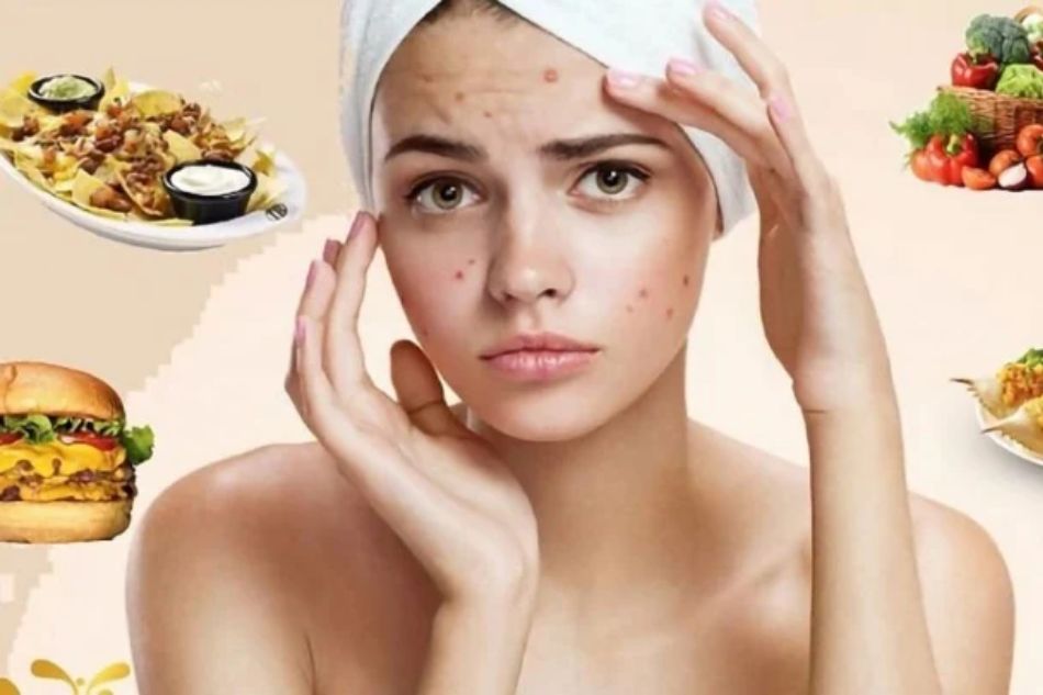 Chế độ ăn uống không lành mạnh có thể gây mụn trên da Chế độ ăn uống không lành mạnh có thể gây mụn trên da