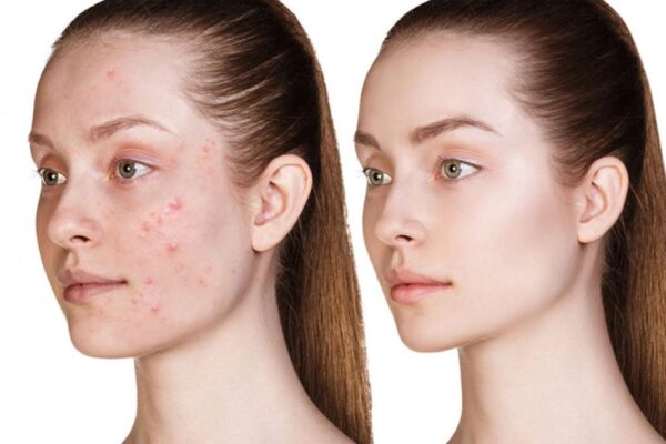 uống gì để hết mụn