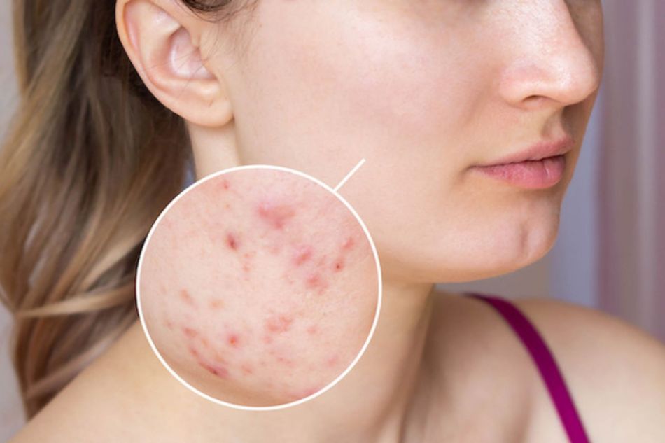 Uống trà sữa quá nhiều khiến da bị nổi mụn Uống trà sữa quá nhiều khiến da bị nổi mụn